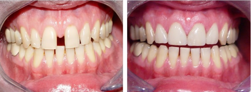 تفلج الاسنان